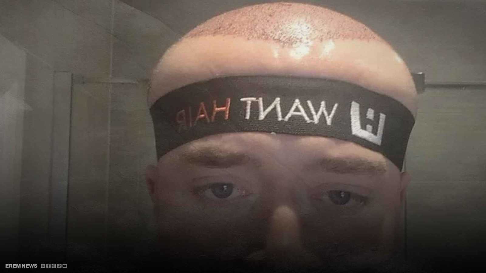 "حلم زرع الشعر يتحوّل كابوساً".. تورّم رهيب يغيّر ملامحه بالكامل (فيديو إرم)