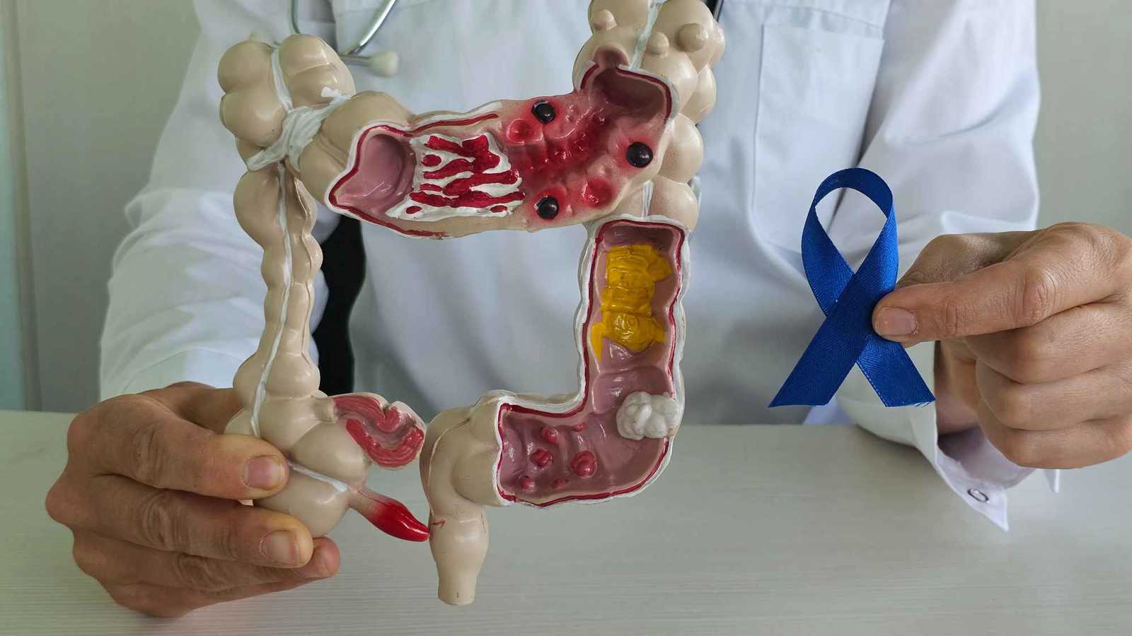 ارتفاع مقلق في حالات سرطان الزائدة الدودية بين الشبان