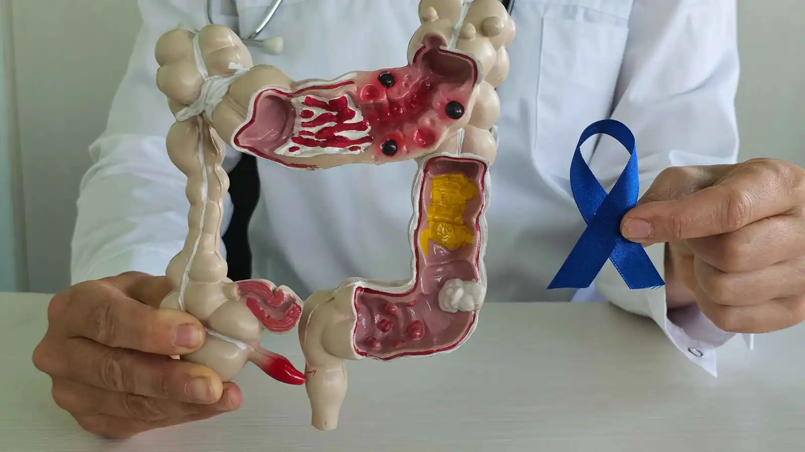 ارتفاع مقلق في حالات سرطان الزائدة الدودية بين الشبان