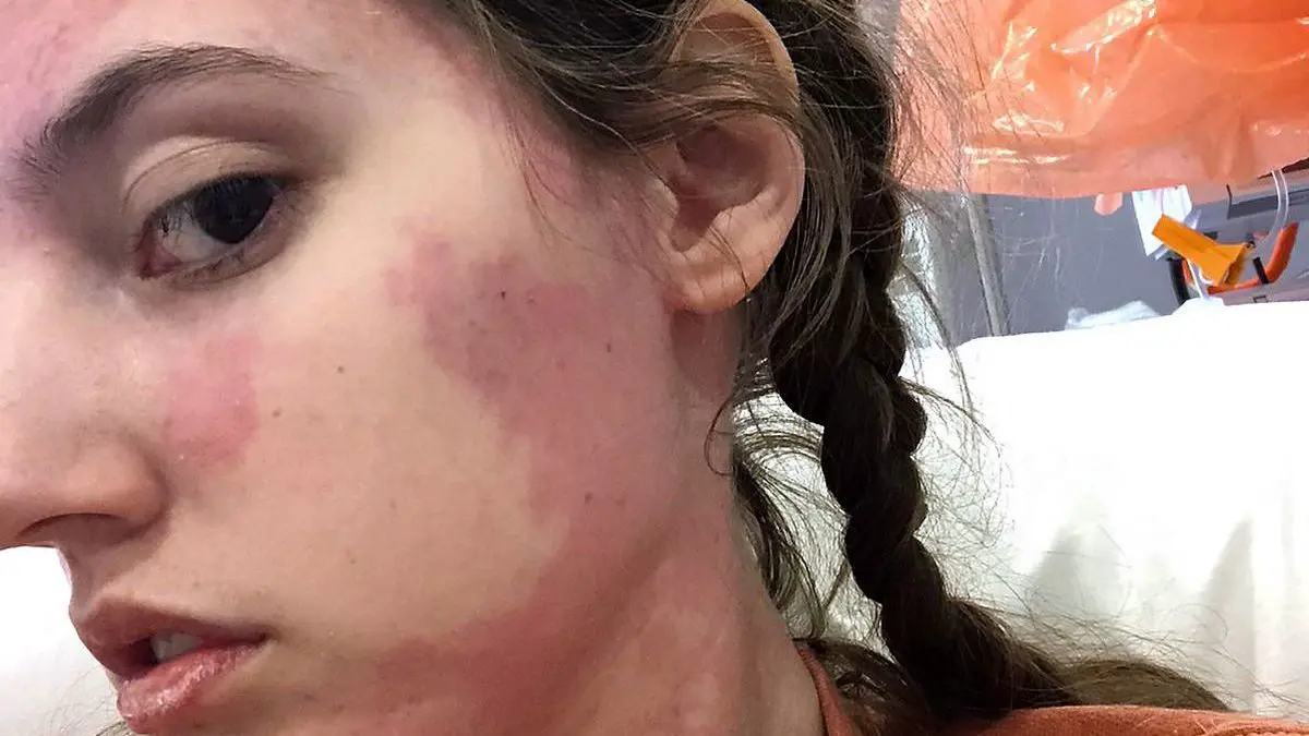 بسبب مرض غريب.. بريطانية "تتناول" غذاءها عن طريق القلب (صور)