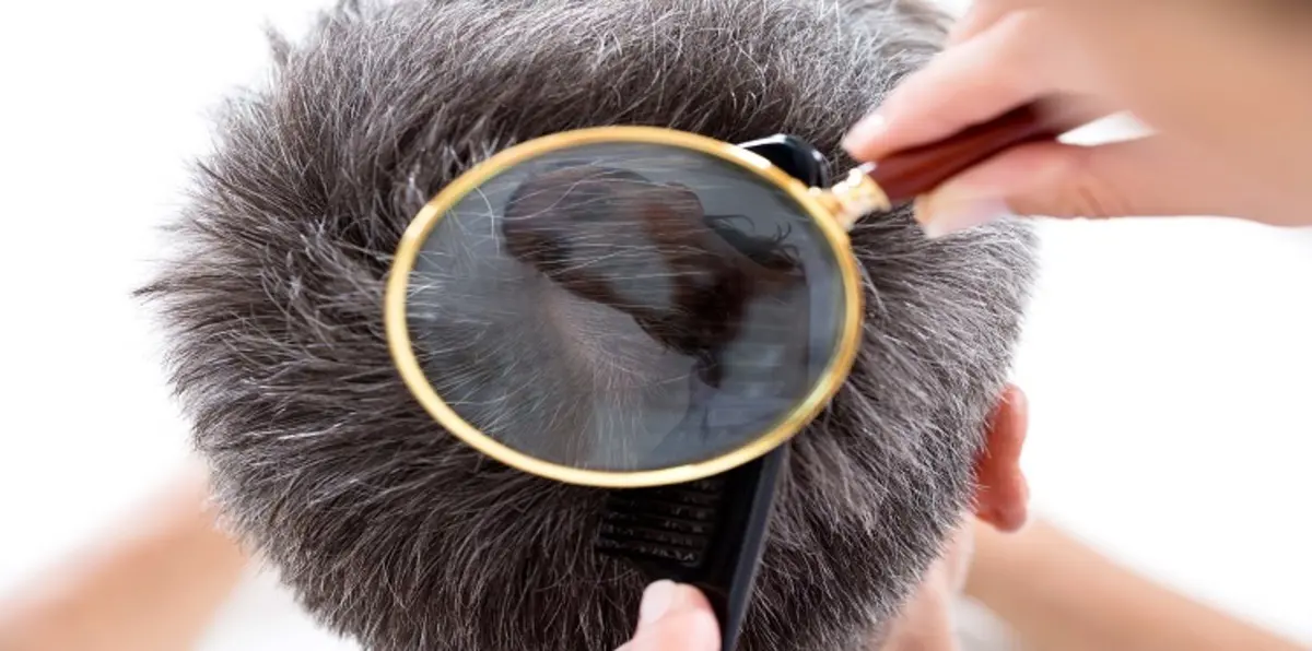 كيف تمنع ظهور الشعر الأبيض في سن الشباب؟‎