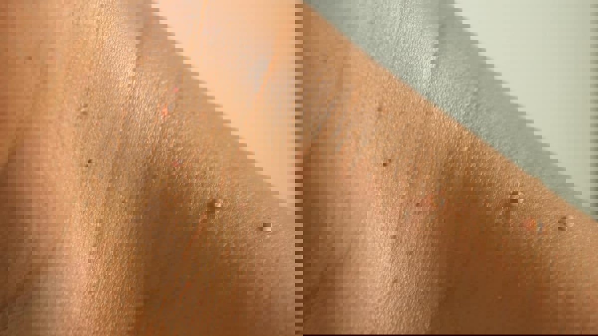 الزوائد الجلدية.. ما هي وكيف تتم إزالتها؟