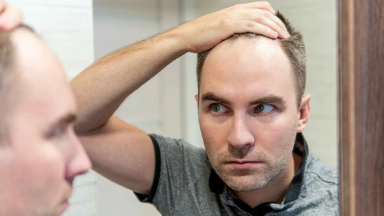 لا يخلو من آثار جانبية.. بروز علاج "ثوري" للصلع الوراثي