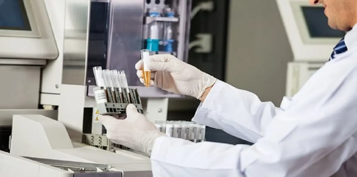 ابتكار تحليل بول ثوري يكشف سرطان المثانة