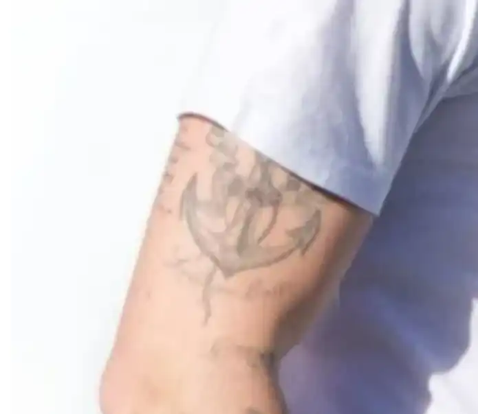 بعد ازالة الوشم