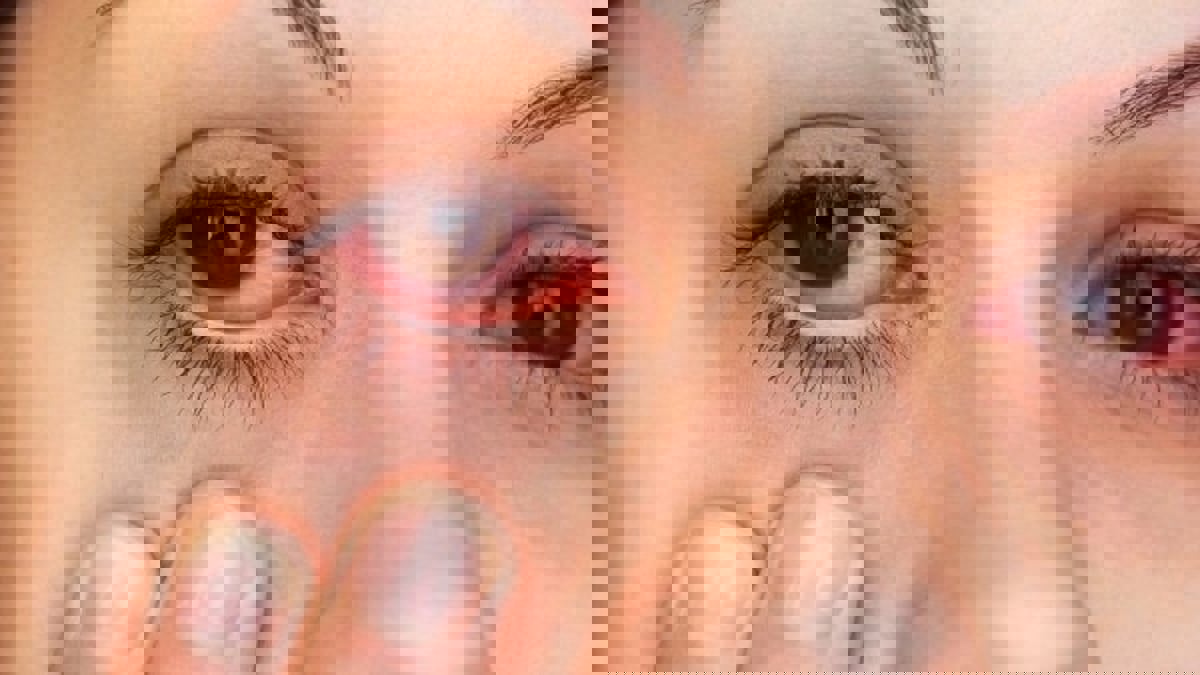 جفاف العين.. يؤثر سلبًا على الصحة الجسدية والنفسية