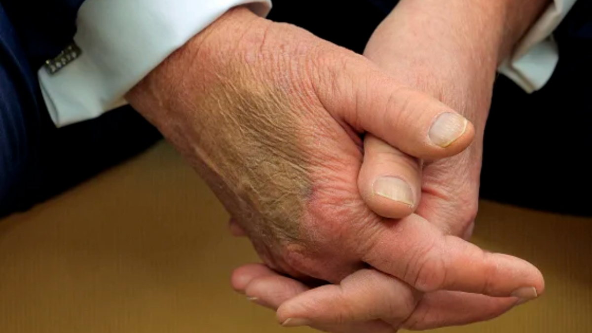 البيت الأبيض يكشف سبب الكدمات على يد ترامب