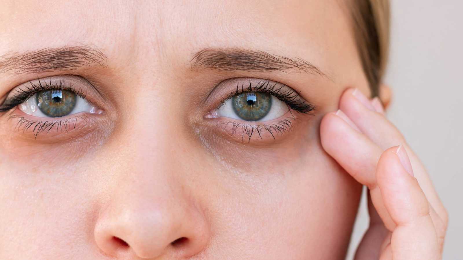 كيف يؤثر نقص الفيتامينات على تكوين الهالات تحت العينين؟