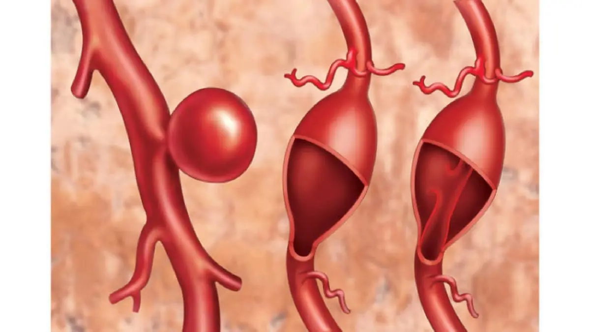 "أم الدم".. ماذا تعرف عن المرض المميت؟