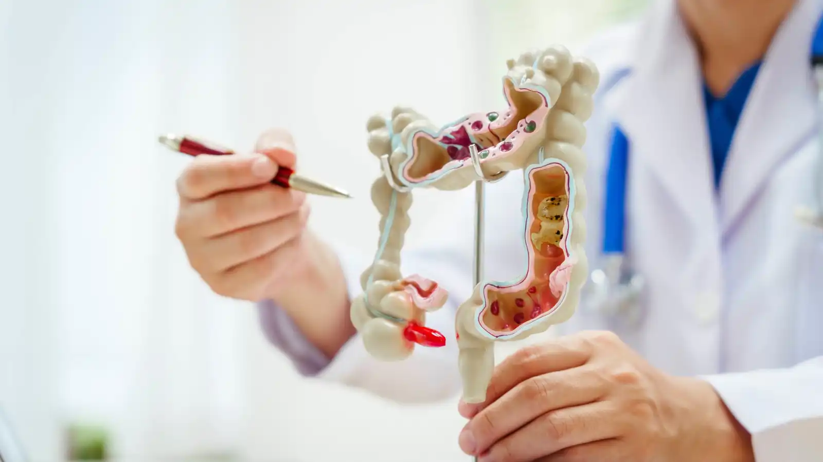 تصلب القولون المزمن قد يزيد خطر الإصابة بالسرطان لدى الشباب