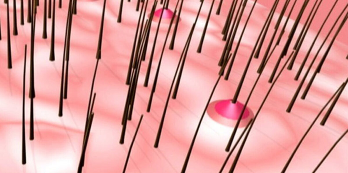 علاج الخلايا التالفة باستخدام بصيلات الشعر