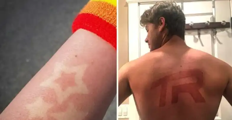 تحدي وشم حروق الشمس