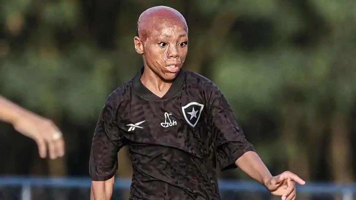 نجا بمعجزة من الحروق لينضم إلى ناد كبير.. ما قصة بيرناردو لوبيز؟ (صور)