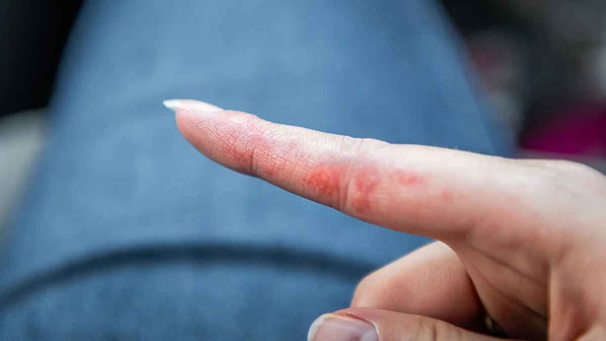 هل تزعجك النتوءات الصغيرة على الأصابع أو الذراعين؟.. إليك السبب