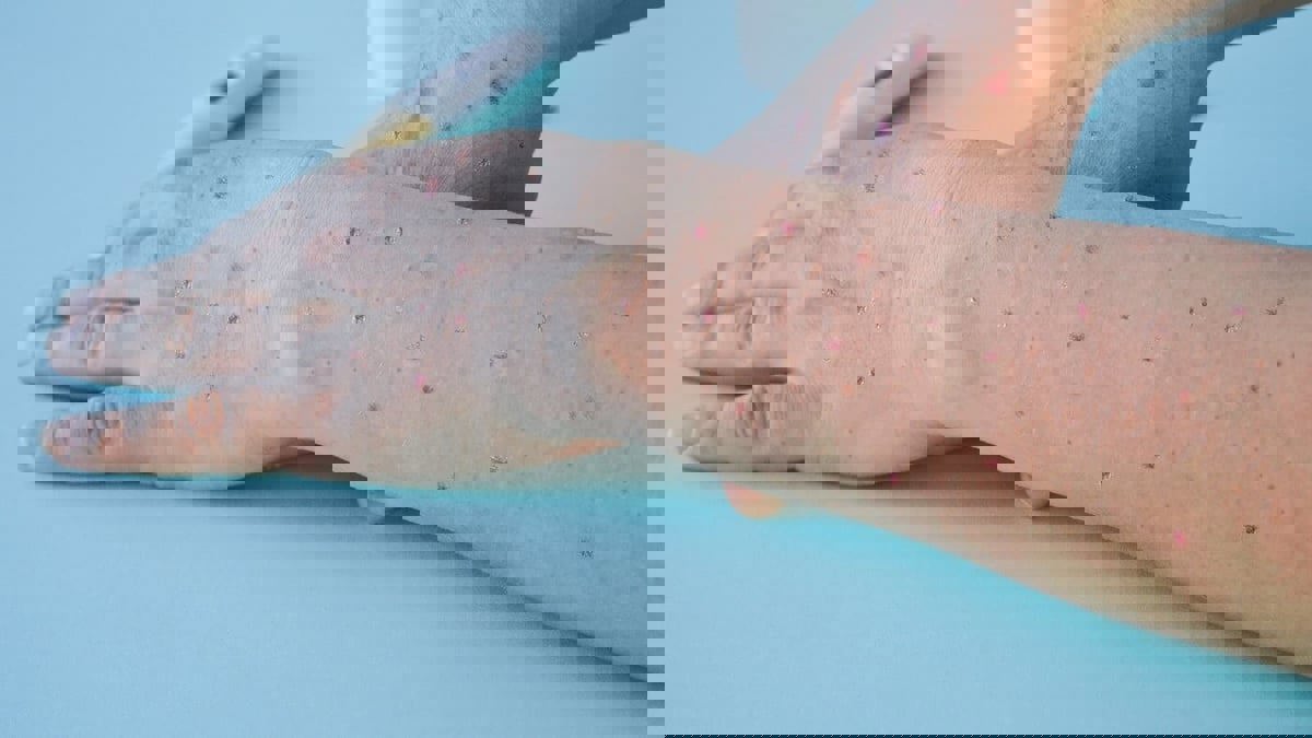 الهند تؤكد أول وفاة بجدري القردة