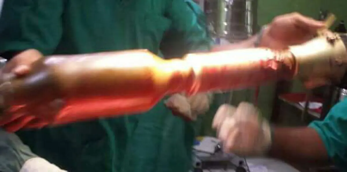 الأطباء يستخرجون بنجاح صاروخاً استقر بجسد جندي يمني