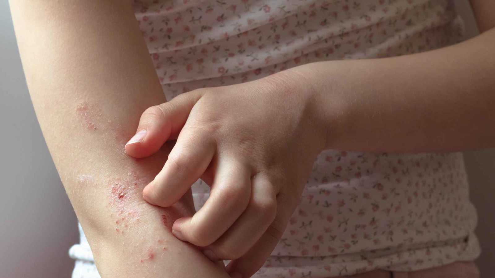 الحرارة والتلوث يرفعان معدلات الإكزيما والصدفية عالميًا