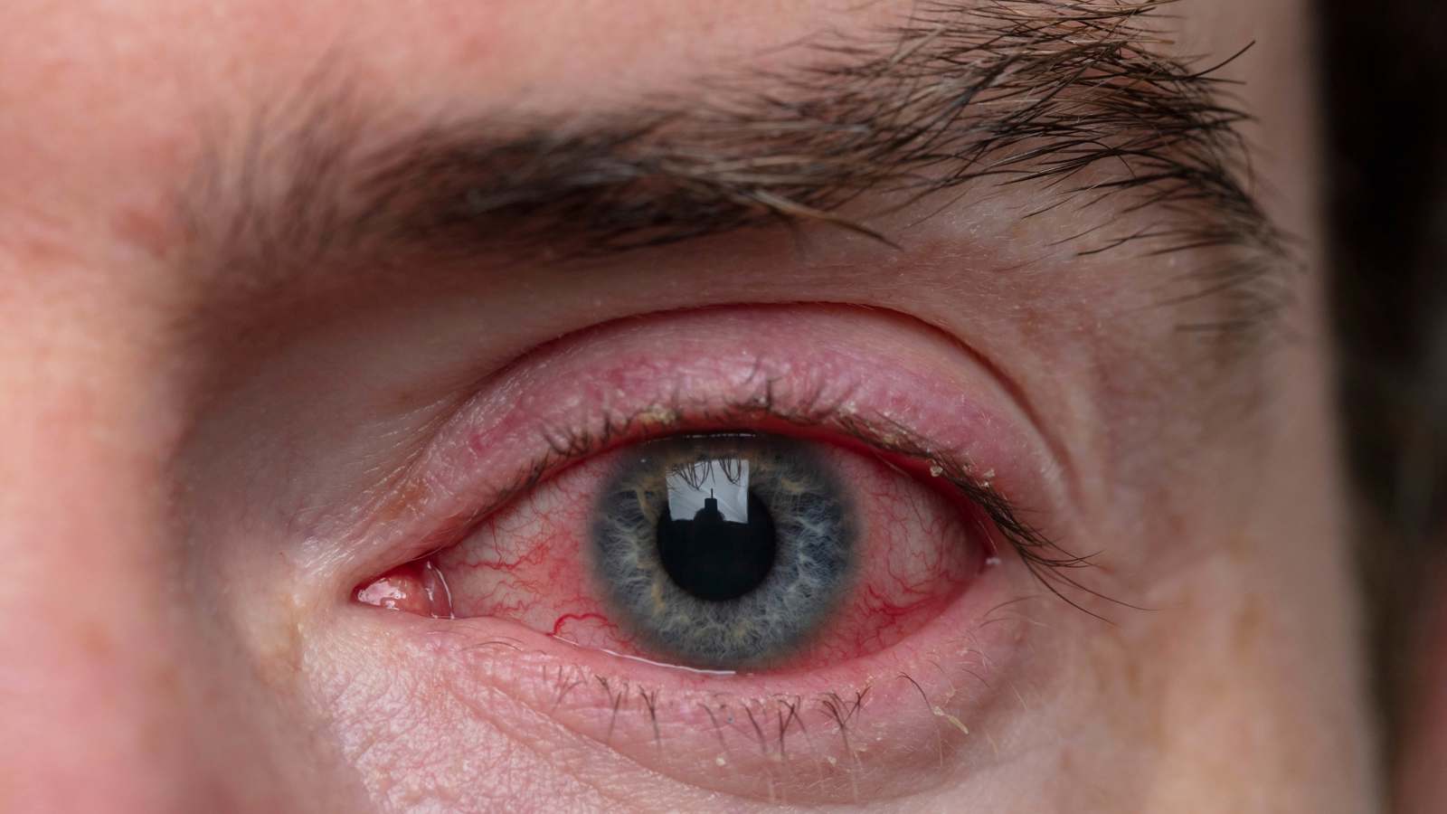 "العين الوردية".. هل هي معدية وكيف يمكن علاجها؟