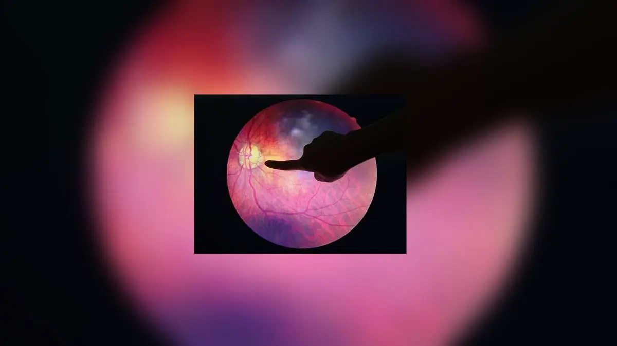 اكتشاف إنزيم يمنع العمى الناتج عن داء السكري