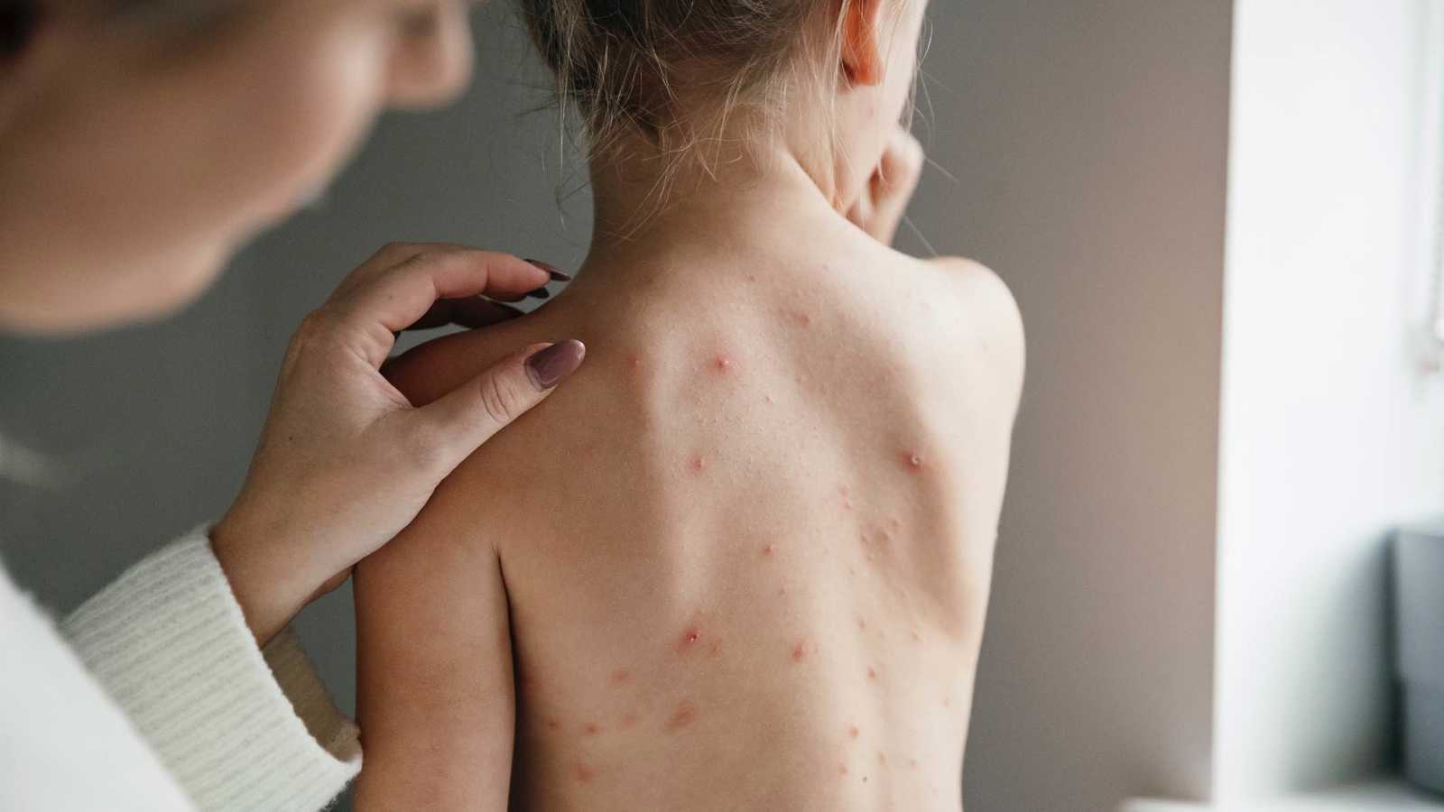 طرق منزلية لتخفيف حكة جدري الماء لدى الأطفال