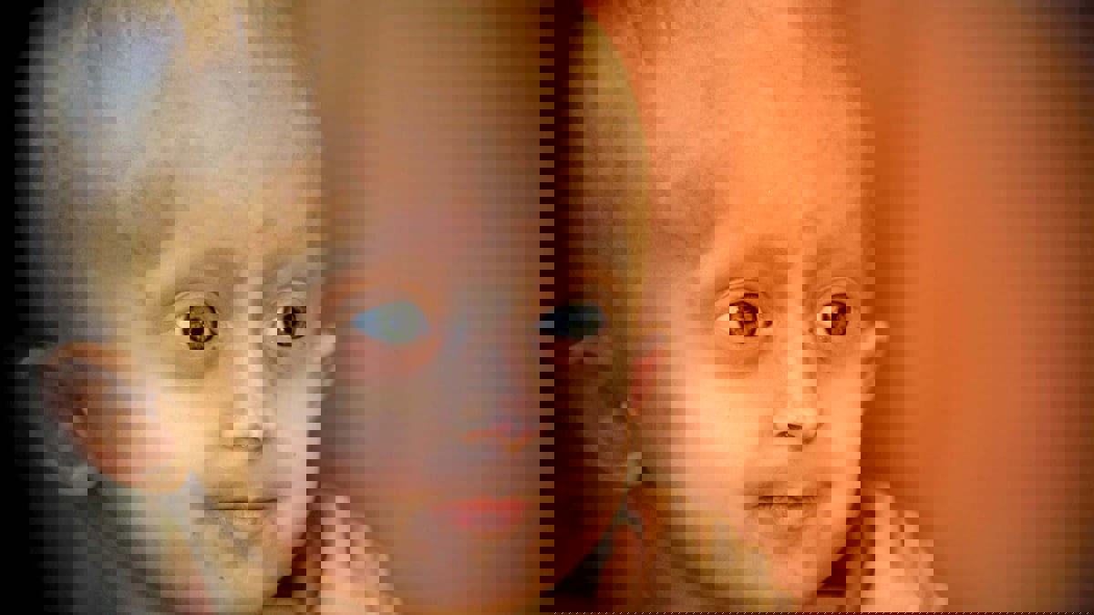 أمريكا.. الموافقة على أول دواء لعلاج الشيخوخة المبكرة لدى الأطفال