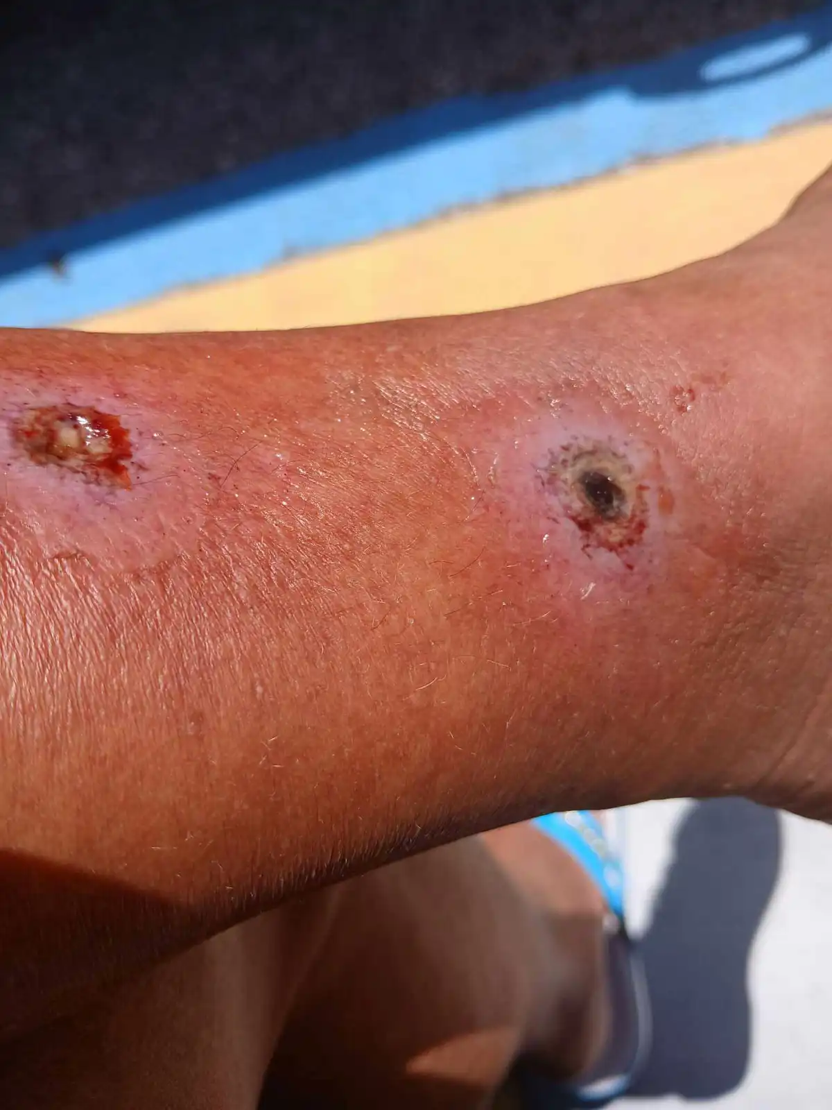 لدغات العنكبوت في ساق باتريشا