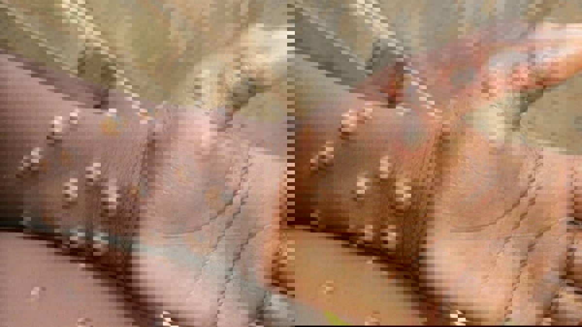 السودان يسجل أول إصابة بجدري القرود