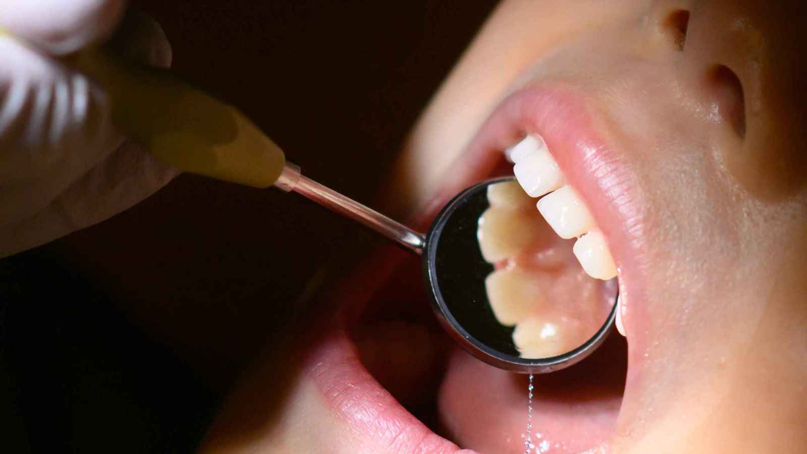 طبيب أسنان يثير الجدل بعلاج المرضى في شوارع دمشق (فيديو)