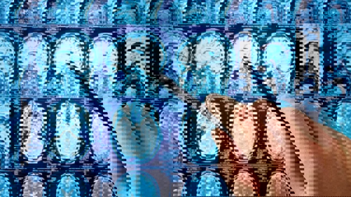 أطباء يعثرون على "ديدان" في دماغ رجل يعاني من صداع نصفي 
