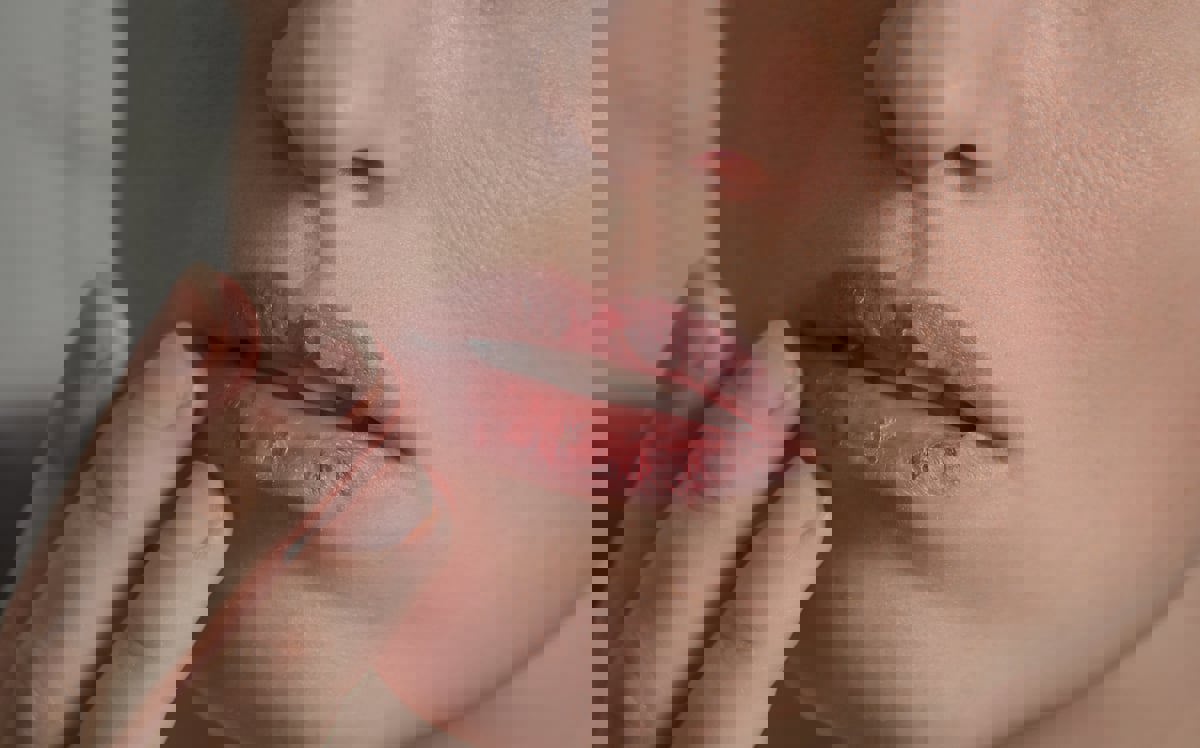 5 أسباب لجفاف وتشقق الشفاه في فصل الصيف