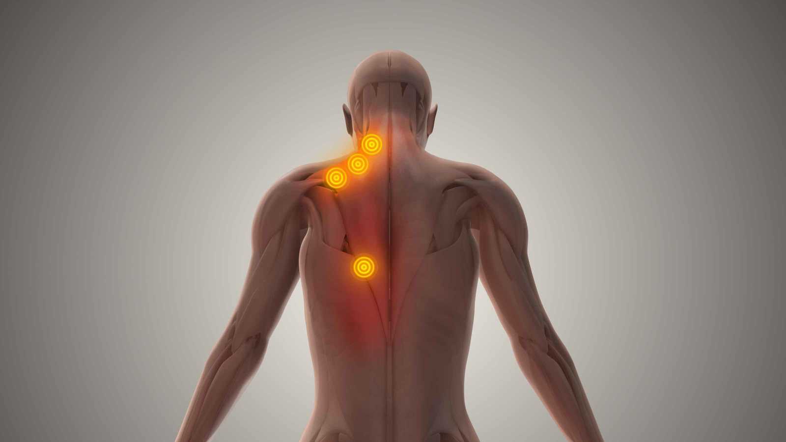 "عُقد الألم الصامتة".. كيف تسيطر نقاط الزناد على 85% من جسدك؟