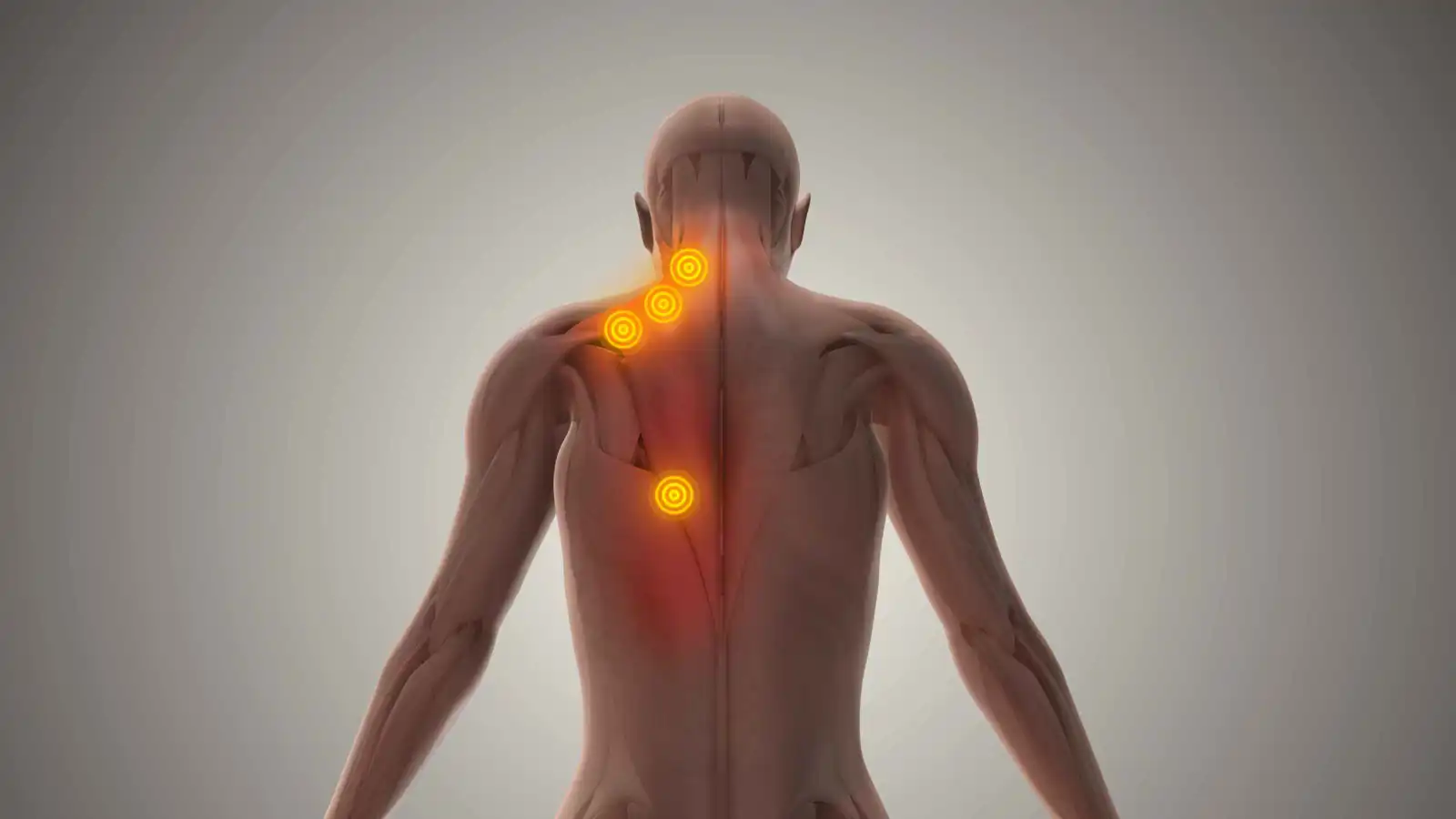 "عُقد الألم الصامتة".. كيف تسيطر نقاط الزناد على 85% من جسدك؟