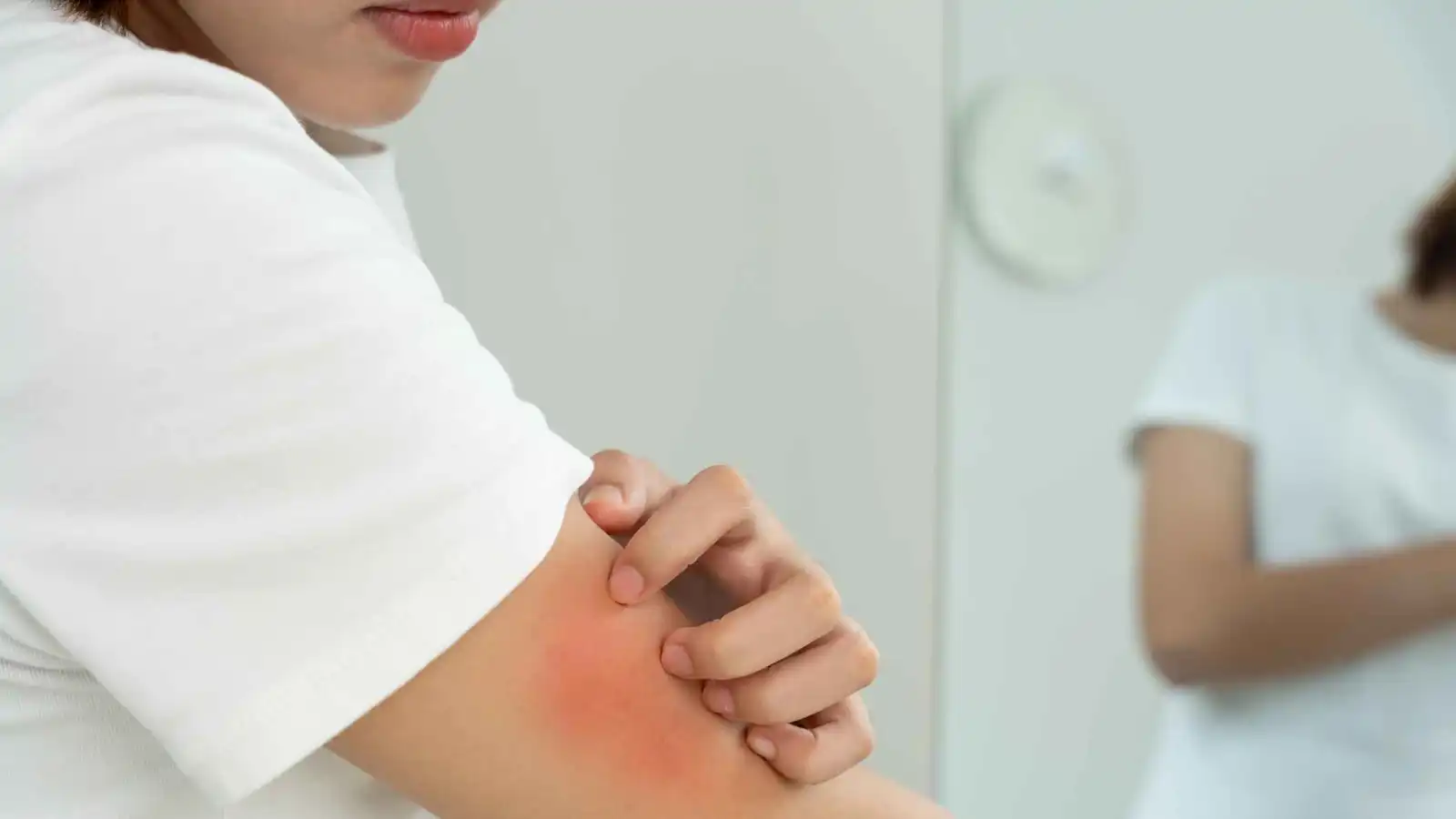 لدغات البعوض - تعبيرية