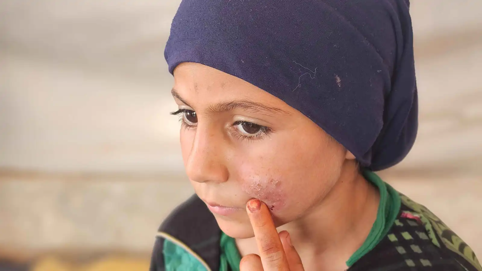 درعا السورية تسجل 133 إصابة بمرض اللاشمانيا