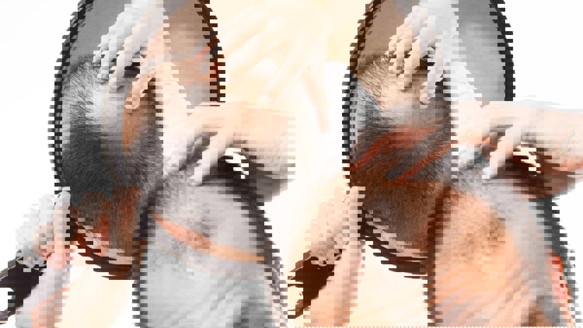 هل نقول وداعا للصلع قريبا؟