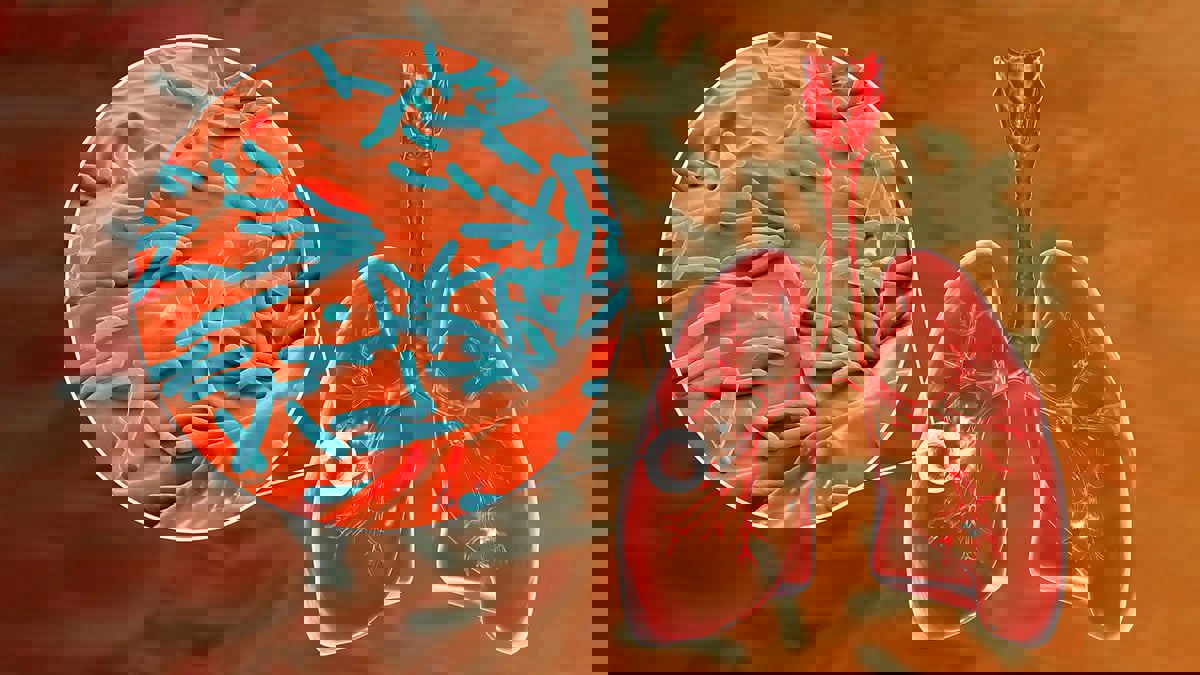 علاج جديد يطلق "بداية نهاية" مرض السل المقاوم للأدوية