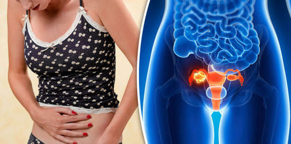 اكتشاف جديد لعلاج ورم سرطان المبيض