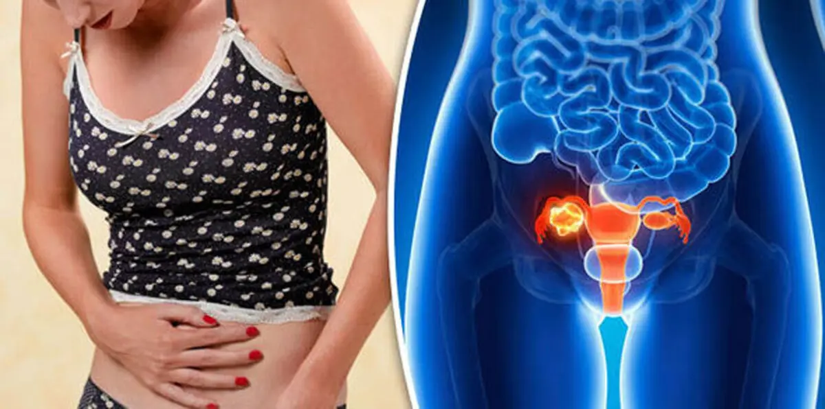 اكتشاف جديد لعلاج ورم سرطان المبيض