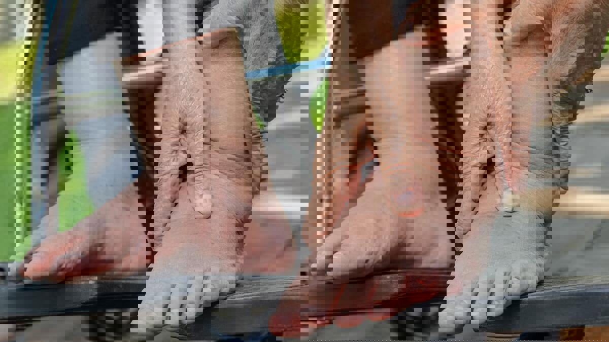 مؤشر على أمراض خطيرة.. ماذا تعرف عن "الوذمة"؟ 