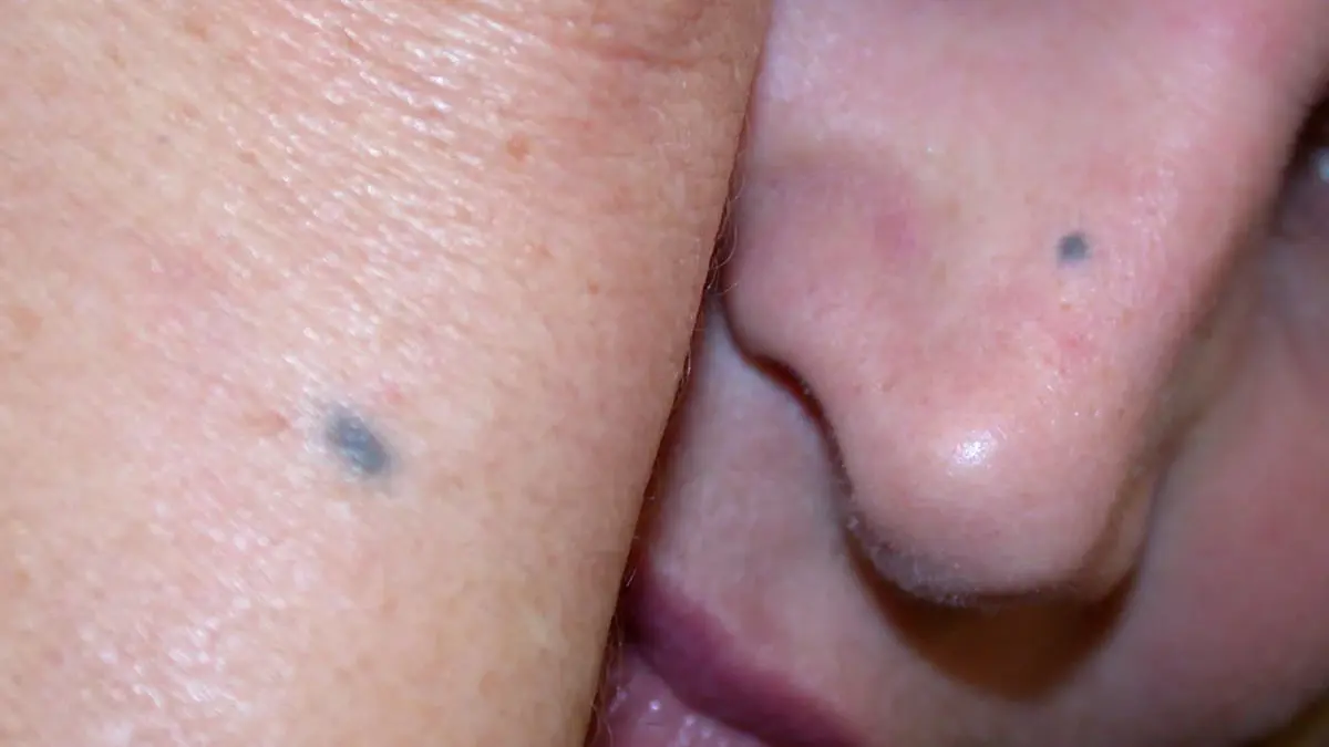 احذر.. ظهور بقع زرقاء على الجلد قد يكون مؤشرًا خطيرًا