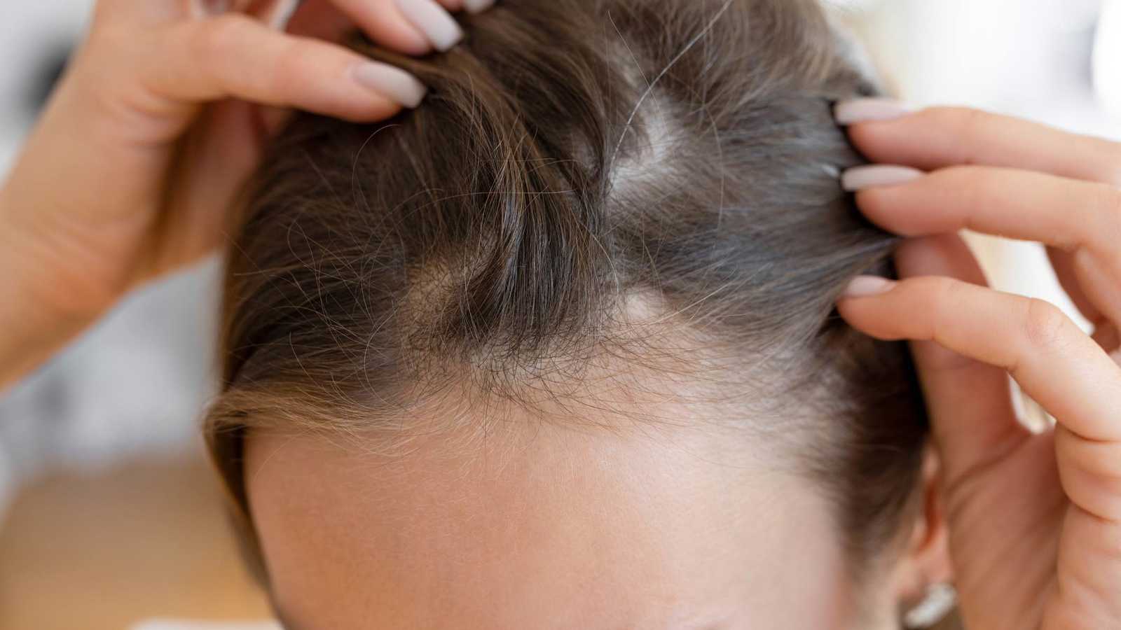 الصلع.. موروث من جهة الأم أم الأب؟