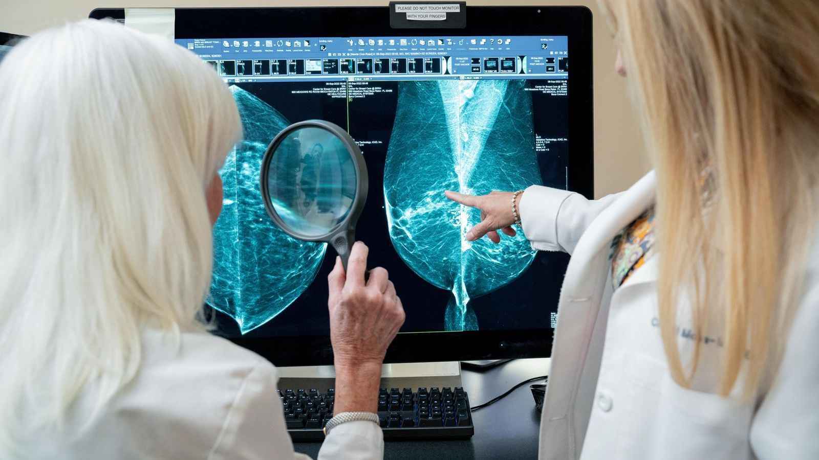 الذكاء الاصطناعي يتفوق بالكشف عن سرطان الثدي