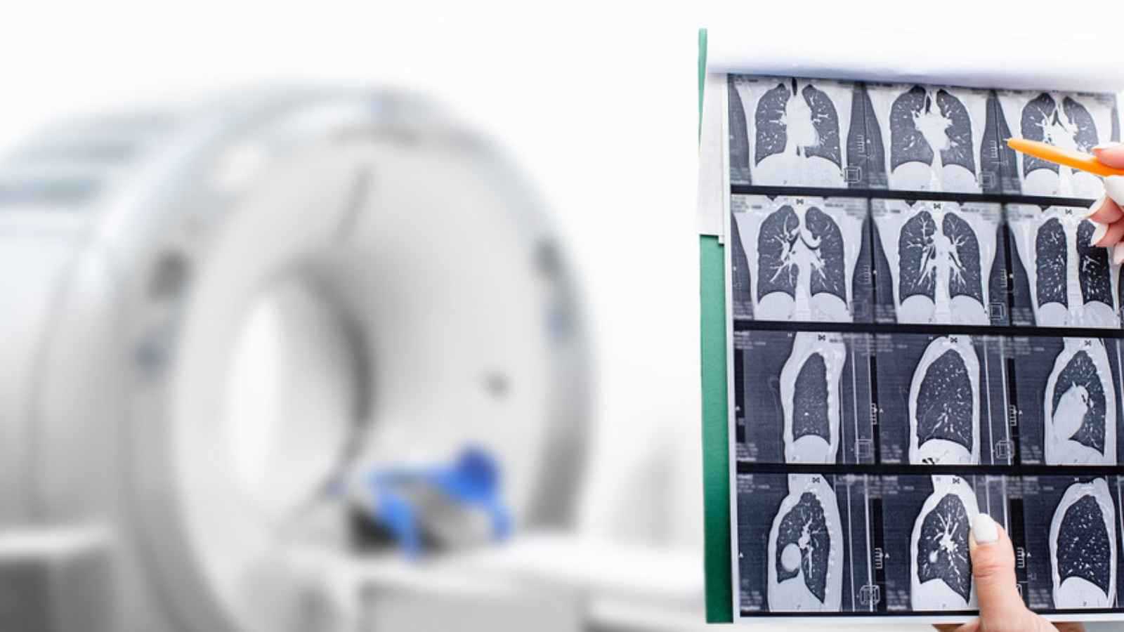 اكتشاف علمي يفتح آفاقاً جديدة في علاج أخطر سرطانات الرئة