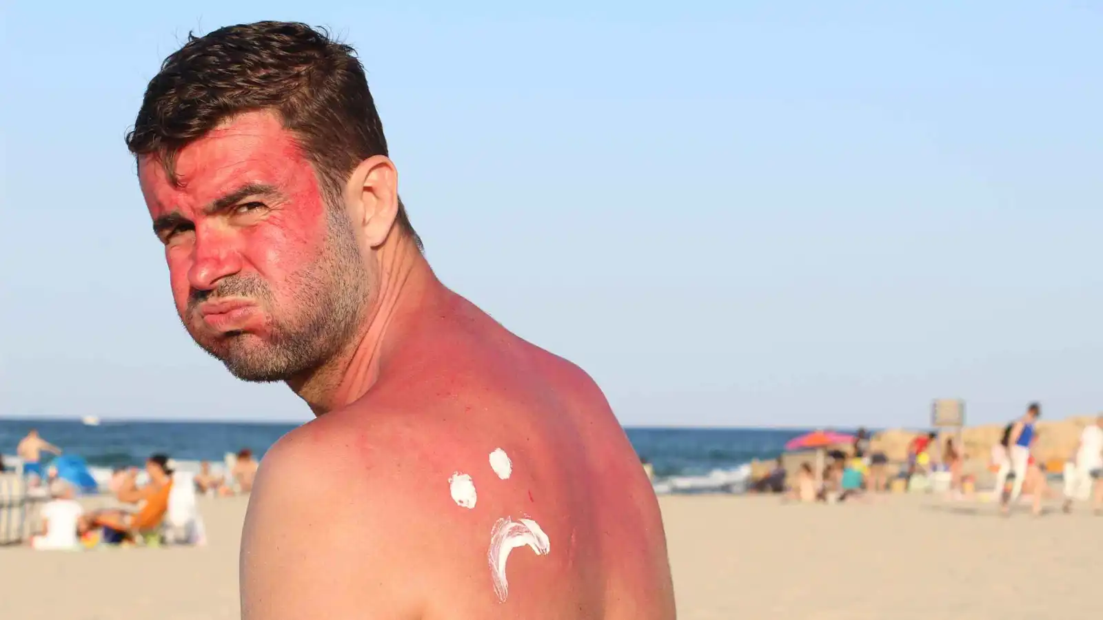 الشاي الأسود والحليب البارد.. حلول "مذهلة" لحروق الشمس