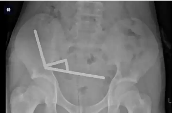 صورة أشعة لأمعاء الطفل 