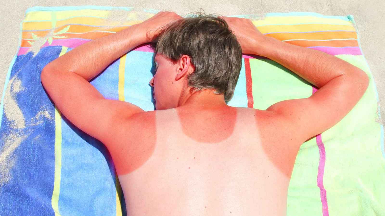 اكتشاف سبب جديد لحروق الشمس