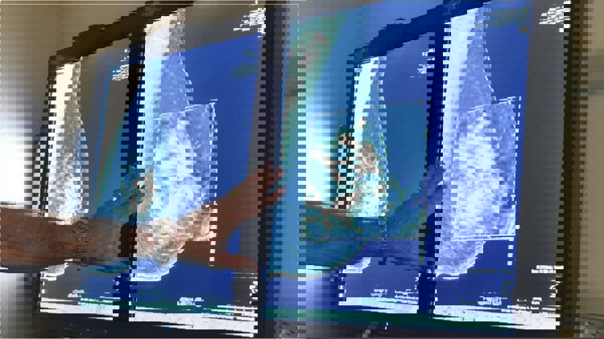 "تغيرات جسدية" تنذر بعلامات مبكرة للسرطان 