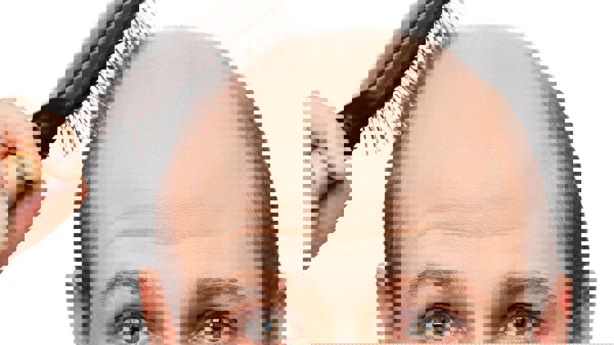 الصين تبتكر لاصقة سحرية تعالج الصلع خلال شهر