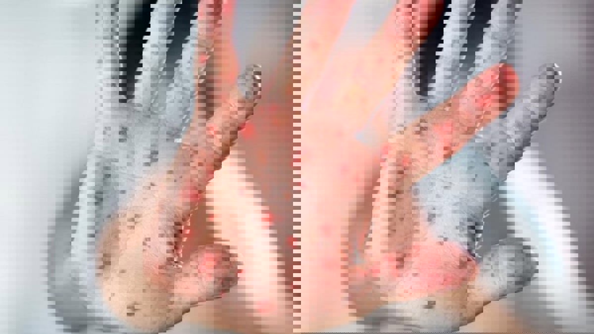 إسرائيل تسجل أول إصابة بـ"جدري القرود"