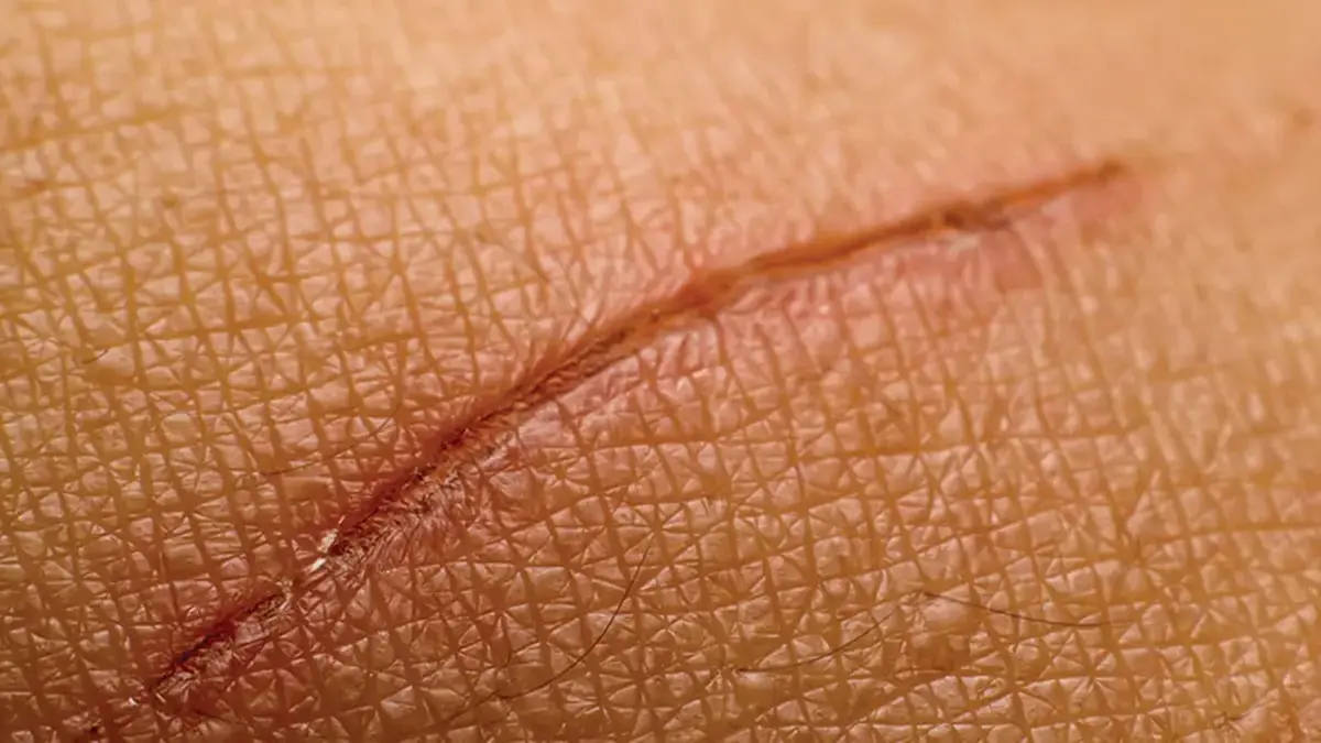 اكتشاف مادة صلصالية تسرع التئام الجروح